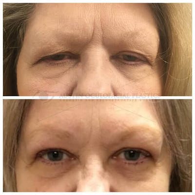 Upper Blepharoplasty Before & After Gallery - Patient 8523747 - Image 1