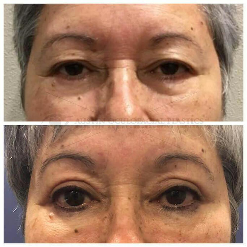 Upper Blepharoplasty Before & After Gallery - Patient 8523750 - Image 1