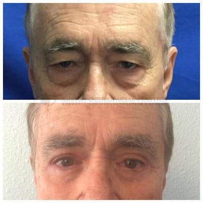 Upper Blepharoplasty Before & After Gallery - Patient 8523751 - Image 1