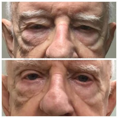 Upper Blepharoplasty Before & After Gallery - Patient 8523752 - Image 1