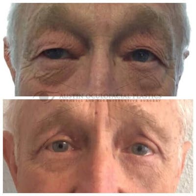Upper Blepharoplasty Before & After Gallery - Patient 8523753 - Image 1