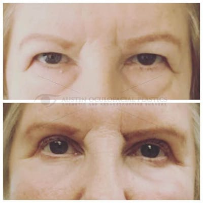 Upper Blepharoplasty Before & After Gallery - Patient 8523755 - Image 1