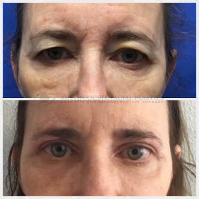 Upper Blepharoplasty Before & After Gallery - Patient 8523756 - Image 1