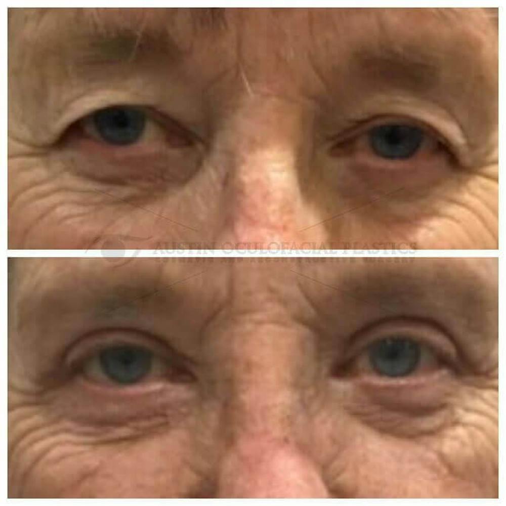 Upper Blepharoplasty Before & After Gallery - Patient 8523770 - Image 1