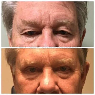 Upper Blepharoplasty Before & After Gallery - Patient 8523772 - Image 1