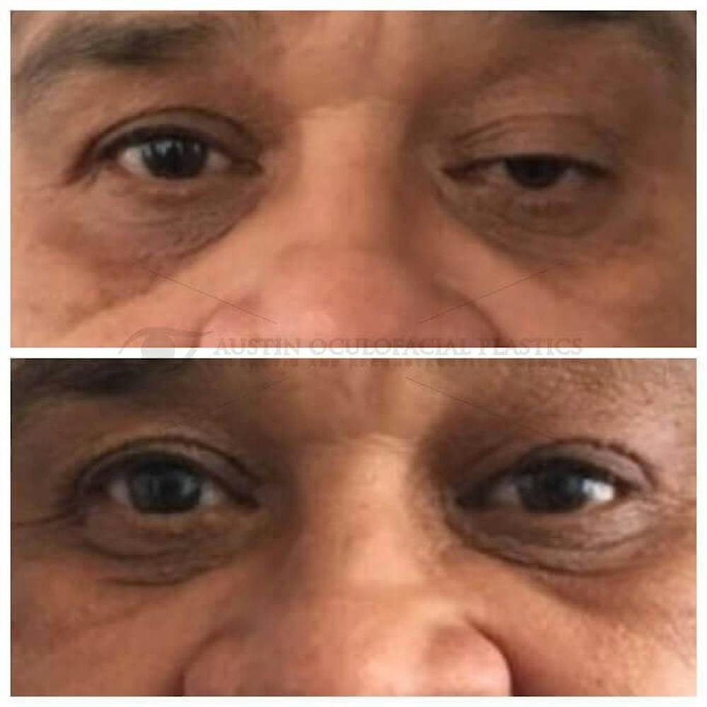 Upper Blepharoplasty Before & After Gallery - Patient 8523773 - Image 1