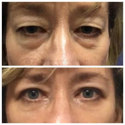 Upper Blepharoplasty Before & After Gallery - Patient 8523775 - Image 1