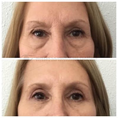Upper Blepharoplasty Before & After Gallery - Patient 8523776 - Image 1