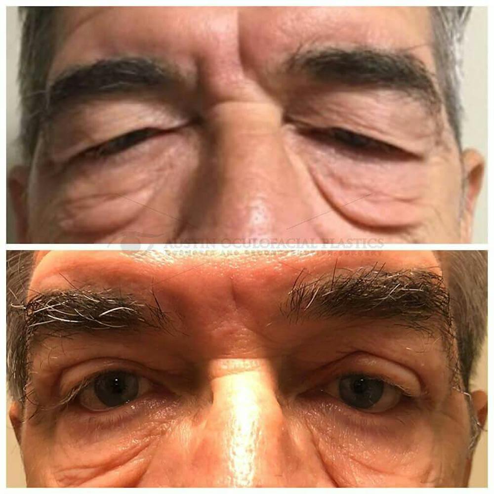 Upper Blepharoplasty Before & After Gallery - Patient 8523777 - Image 1