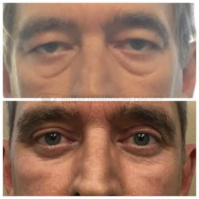 Upper Blepharoplasty Before & After Gallery - Patient 8523778 - Image 1