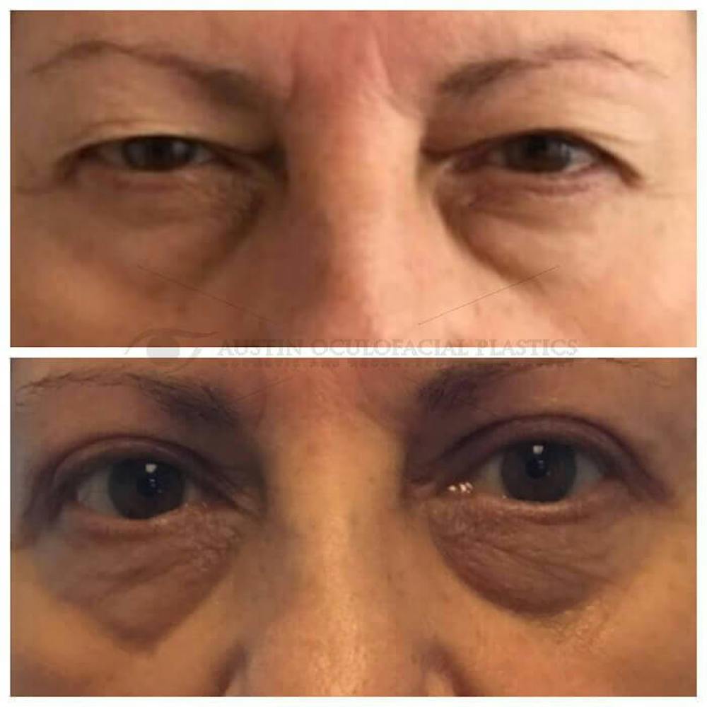 Upper Blepharoplasty Before & After Gallery - Patient 8523780 - Image 1