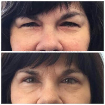 Upper Blepharoplasty Before & After Gallery - Patient 8523781 - Image 1