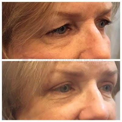Upper Blepharoplasty Before & After Gallery - Patient 8523784 - Image 1