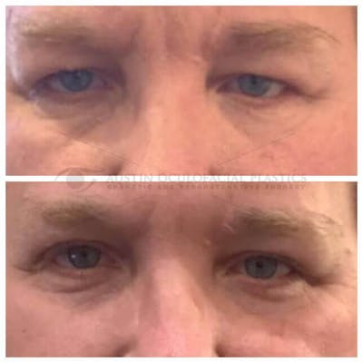 Upper Blepharoplasty Before & After Gallery - Patient 8523785 - Image 1