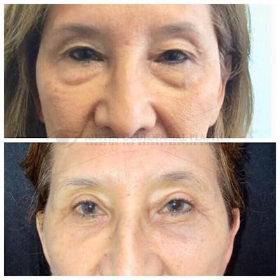 Upper Blepharoplasty Before & After Gallery - Patient 8523786 - Image 1
