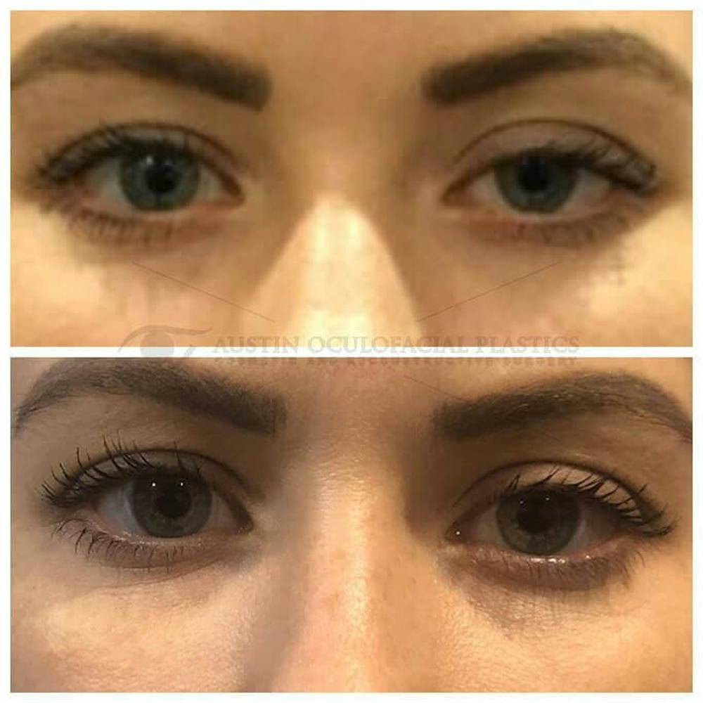 Upper Blepharoplasty Before & After Gallery - Patient 8523787 - Image 1