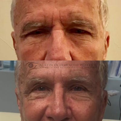 Upper Blepharoplasty Before & After Gallery - Patient 8523788 - Image 1