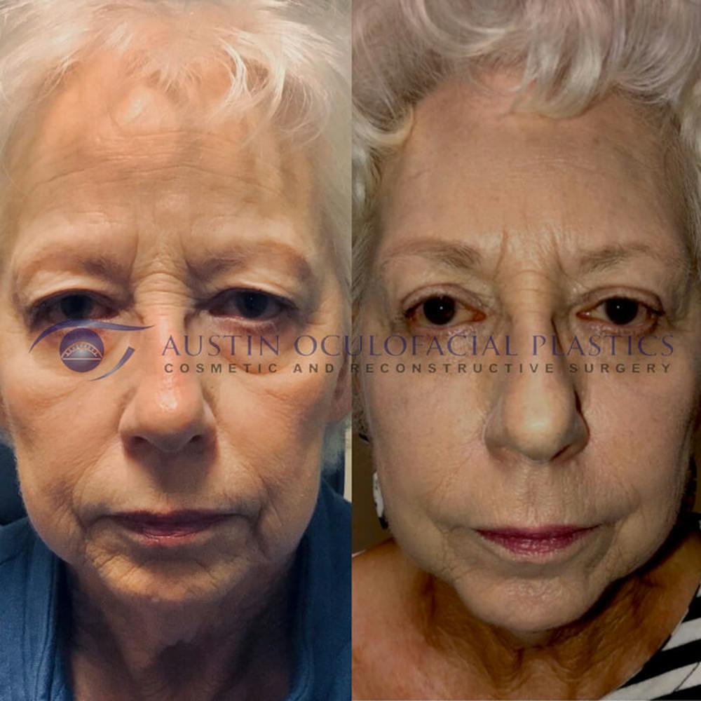 Upper Blepharoplasty Before & After Gallery - Patient 8523789 - Image 1