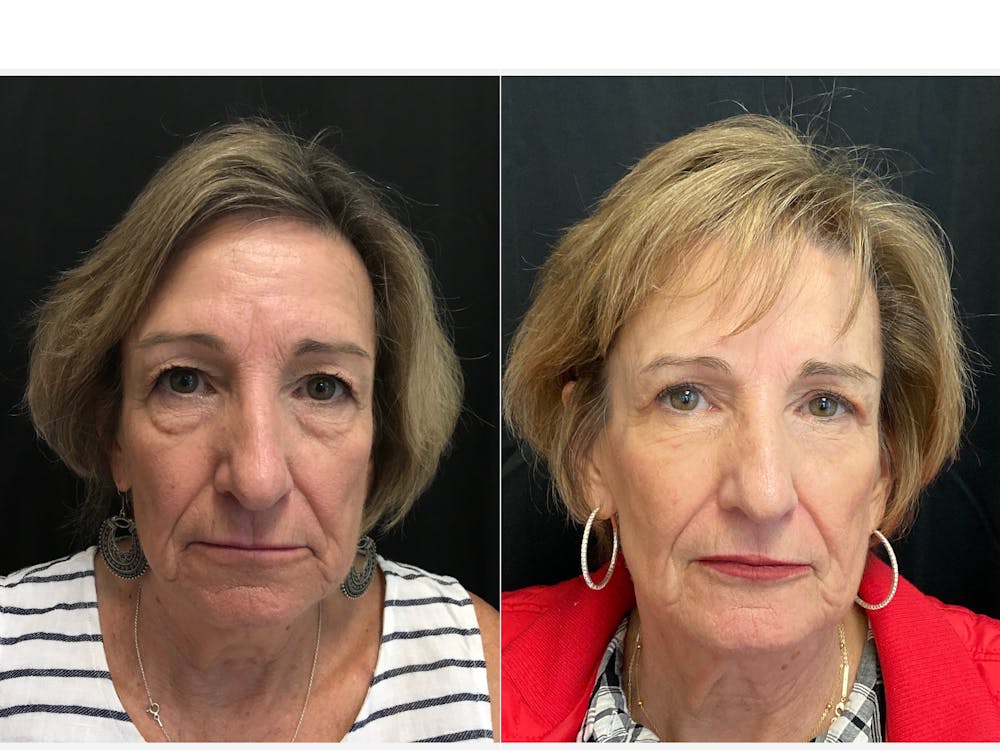 Upper Blepharoplasty Before & After Gallery - Patient 8523790 - Image 1