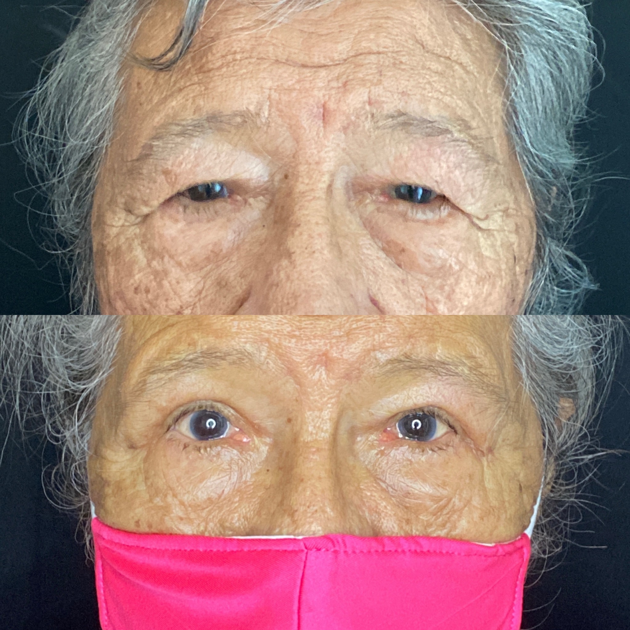 Upper Eyelid Surgery Patients at Austin Face & Body