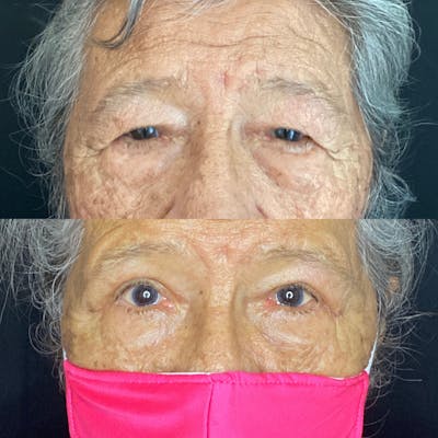 Upper Blepharoplasty Before & After Gallery - Patient 8523791 - Image 1
