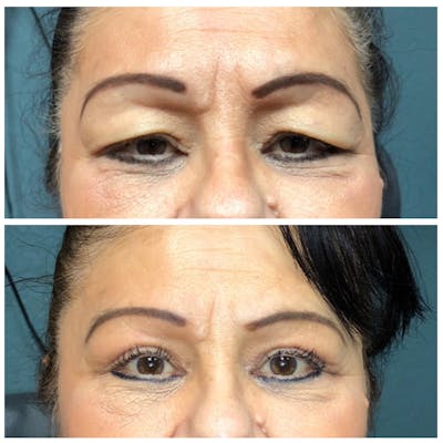 Upper Blepharoplasty Before & After Gallery - Patient 8523793 - Image 1