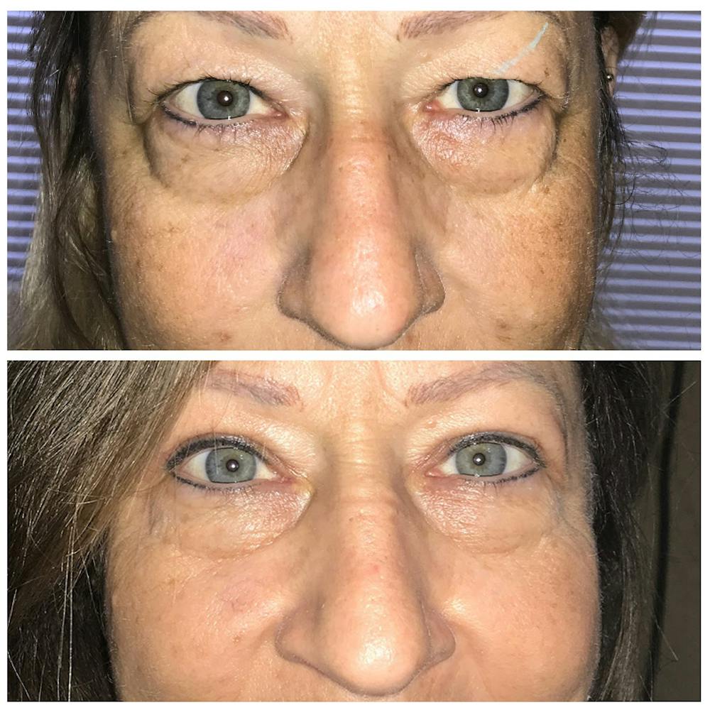 Upper Blepharoplasty Before & After Gallery - Patient 8523795 - Image 1