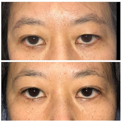 Upper Blepharoplasty Before & After Gallery - Patient 8523796 - Image 1