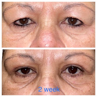Upper Blepharoplasty Before & After Gallery - Patient 8523797 - Image 1