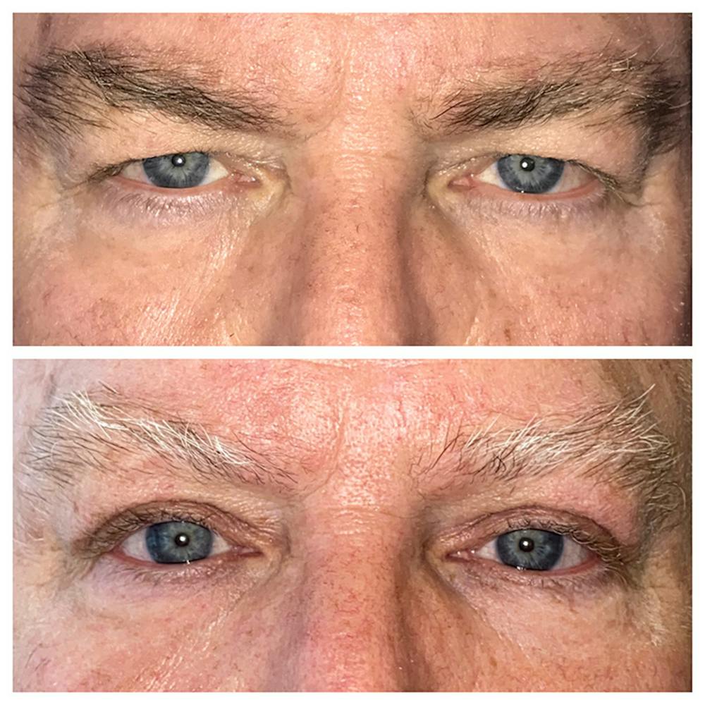 Upper Blepharoplasty Before & After Gallery - Patient 8523799 - Image 1