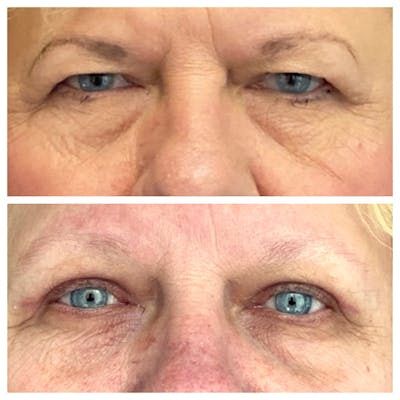 Upper Blepharoplasty Before & After Gallery - Patient 8523800 - Image 1
