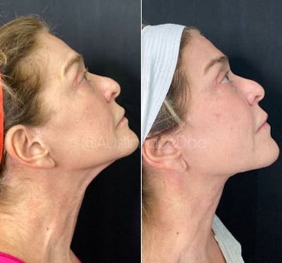 Facetite Before & After Gallery - Patient 8524382 - Image 2
