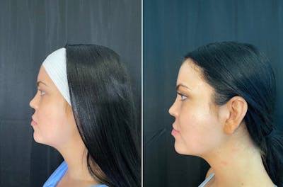 Facetite Before & After Gallery - Patient 8524433 - Image 1