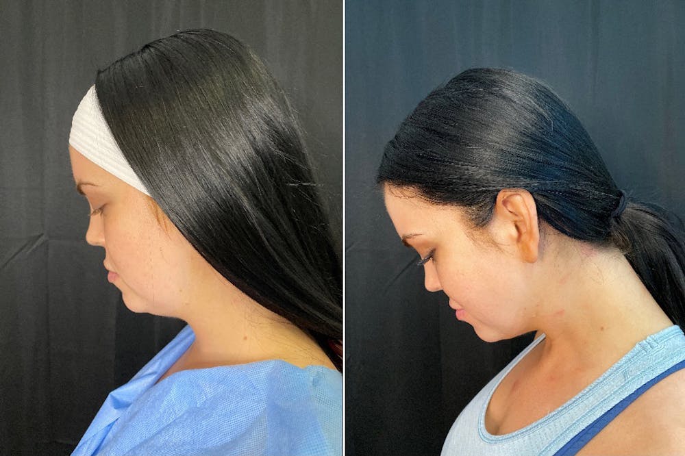 Facetite Before & After Gallery - Patient 8524433 - Image 2