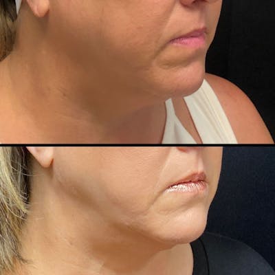 Facetite Before & After Gallery - Patient 8524434 - Image 1