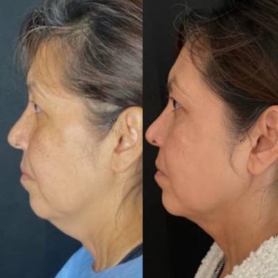 Facetite Before & After Gallery - Patient 8524443 - Image 1