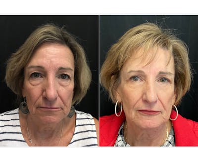 Facetite Before & After Gallery - Patient 8524453 - Image 1
