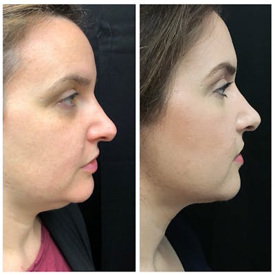 Necklift Before & After Gallery - Patient 8524463 - Image 1
