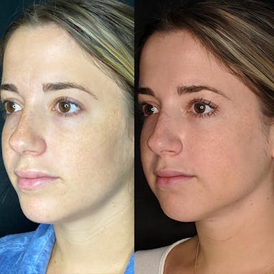 Submental Liposuction Before & After Gallery - Patient 8525020 - Image 1