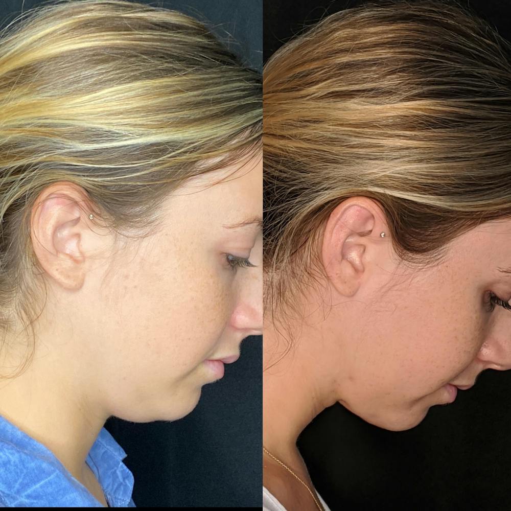 Submental Liposuction Before & After Gallery - Patient 8525020 - Image 2