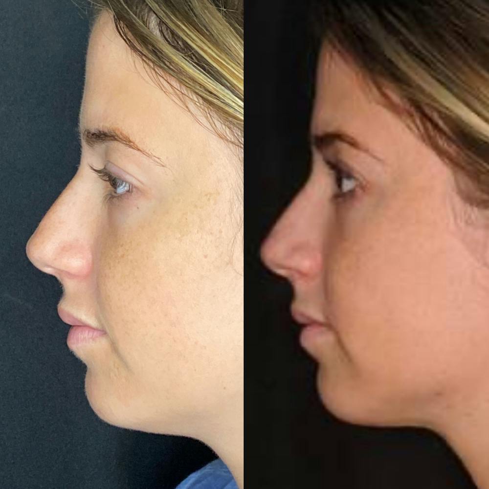 Submental Liposuction Before & After Gallery - Patient 8525020 - Image 3