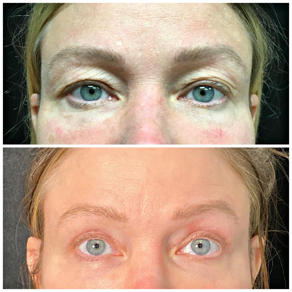 Accutite Before & After Gallery - Patient 8525023 - Image 1