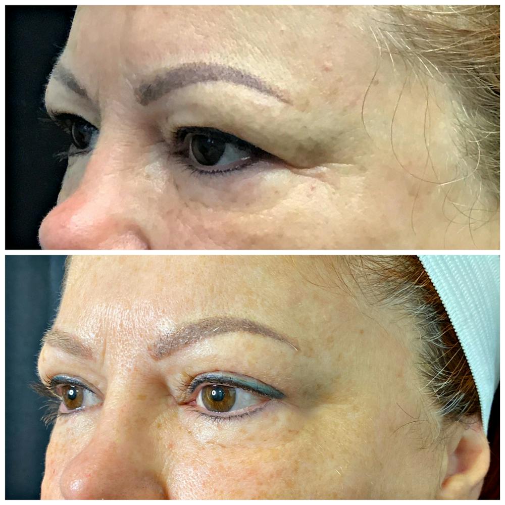 Accutite Before & After Gallery - Patient 8525024 - Image 1