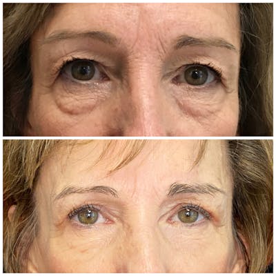 Accutite Before & After Gallery - Patient 8525026 - Image 1