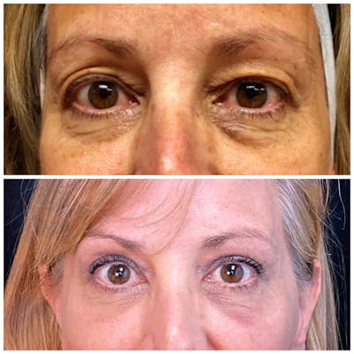 Accutite Before & After Gallery - Patient 8525028 - Image 1