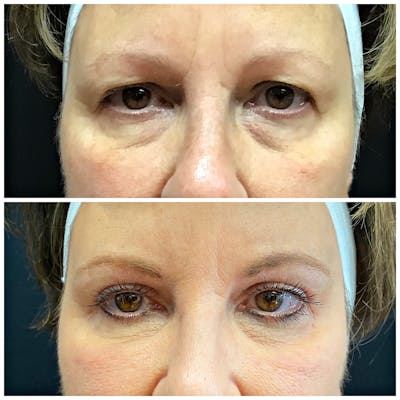 Accutite Before & After Gallery - Patient 8525029 - Image 1