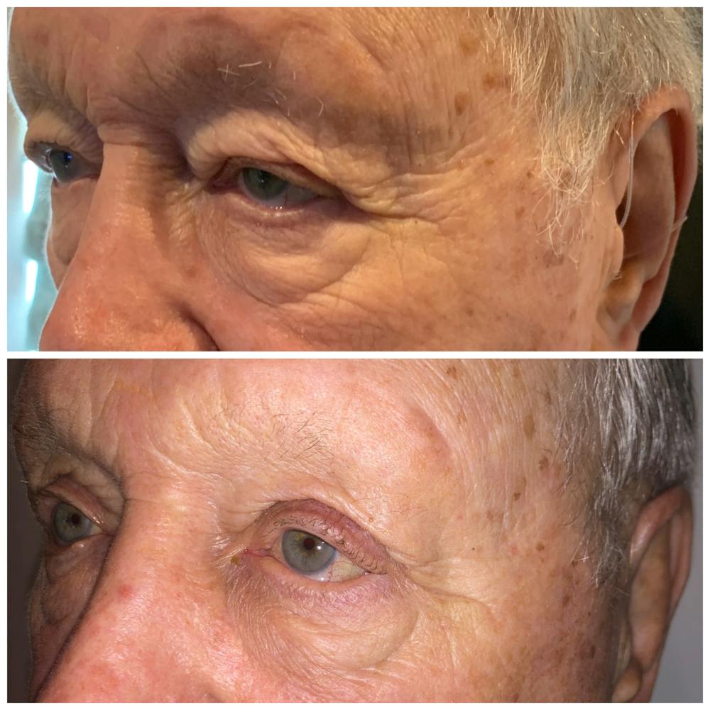 Accutite Before & After Gallery - Patient 8525031 - Image 1