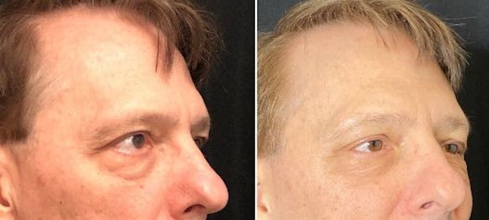 Accutite Before & After Gallery - Patient 8525032 - Image 1