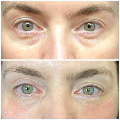 Accutite Before & After Gallery - Patient 8525034 - Image 1