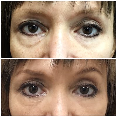 Accutite Before & After Gallery - Patient 8525036 - Image 1